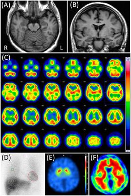 Case Report: Usefulness of Biomarkers for Alzheimer's Disease in Two Cases With Very-Late-Onset Schizophrenia-Like Psychosis